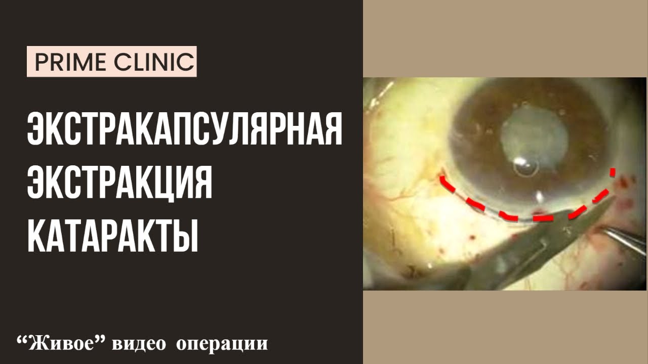 Экстракапсулярная экстракция катаракты ЭЭК - живое видео операции ...