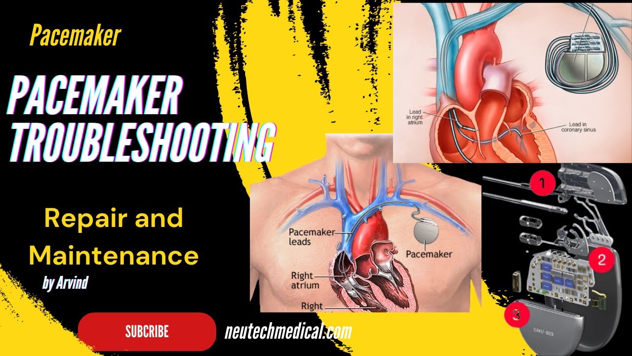 Pacemaker Troubleshooting Pacemaker Bradycardia Unveiled The Heart's
