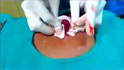 Pimple Removal, cyst removal, blackhead 7