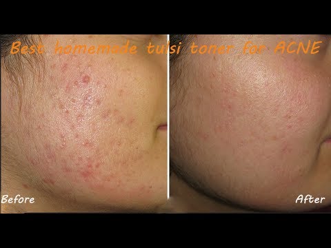 Best home made Tulsi toner for ACNE for Both Male/ Female