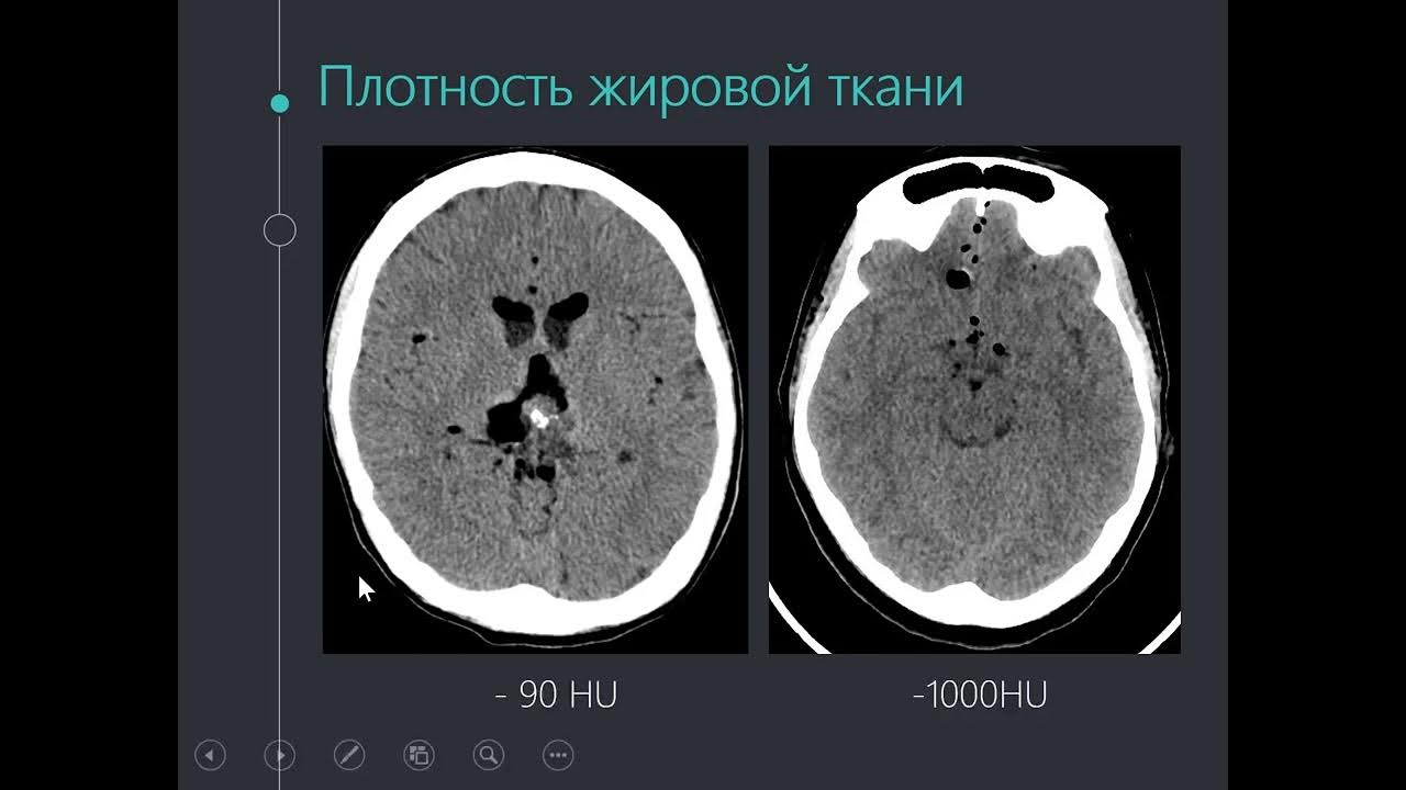 Кт якутск. Мультипланарная реконструкция кт. Плотность тканей на кт. Чтение кт. Очаг на кт в голове повышенной плотности.