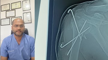 Proximal Humerus K wiring Procedure | Percutaneous Pinning | Dr. Prateek Joshi #fracture #ortho