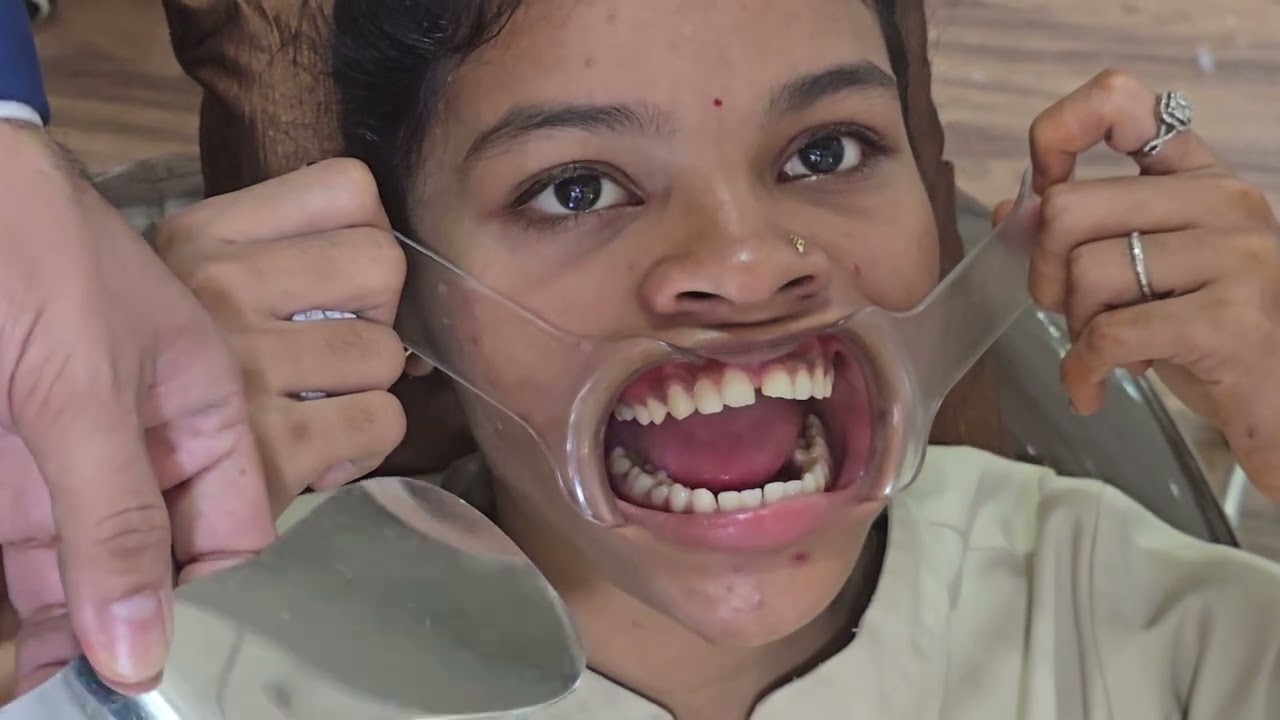 How to use mirror for intraoral pictures