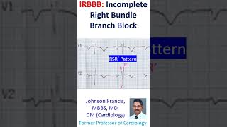 IRBBB: Incomplete Right Bundle Branch Block screenshot 3