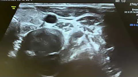 Intervetrabral dise is sometime so well visualized that we feel it is mass. Cervical vertebra scan