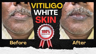 Vitiligo white skin removal specialist in India | Machu clinic | Bangalore | Hyderabad