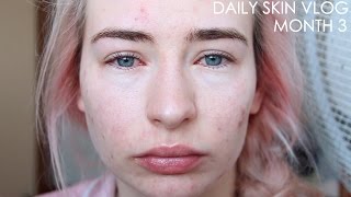 Roaccutane Daily Skin Vlog - Month 3