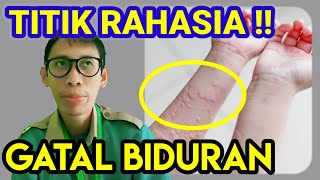 Gatal-gatal pada biduran (Urtikaria), pijat titik akupressur ini