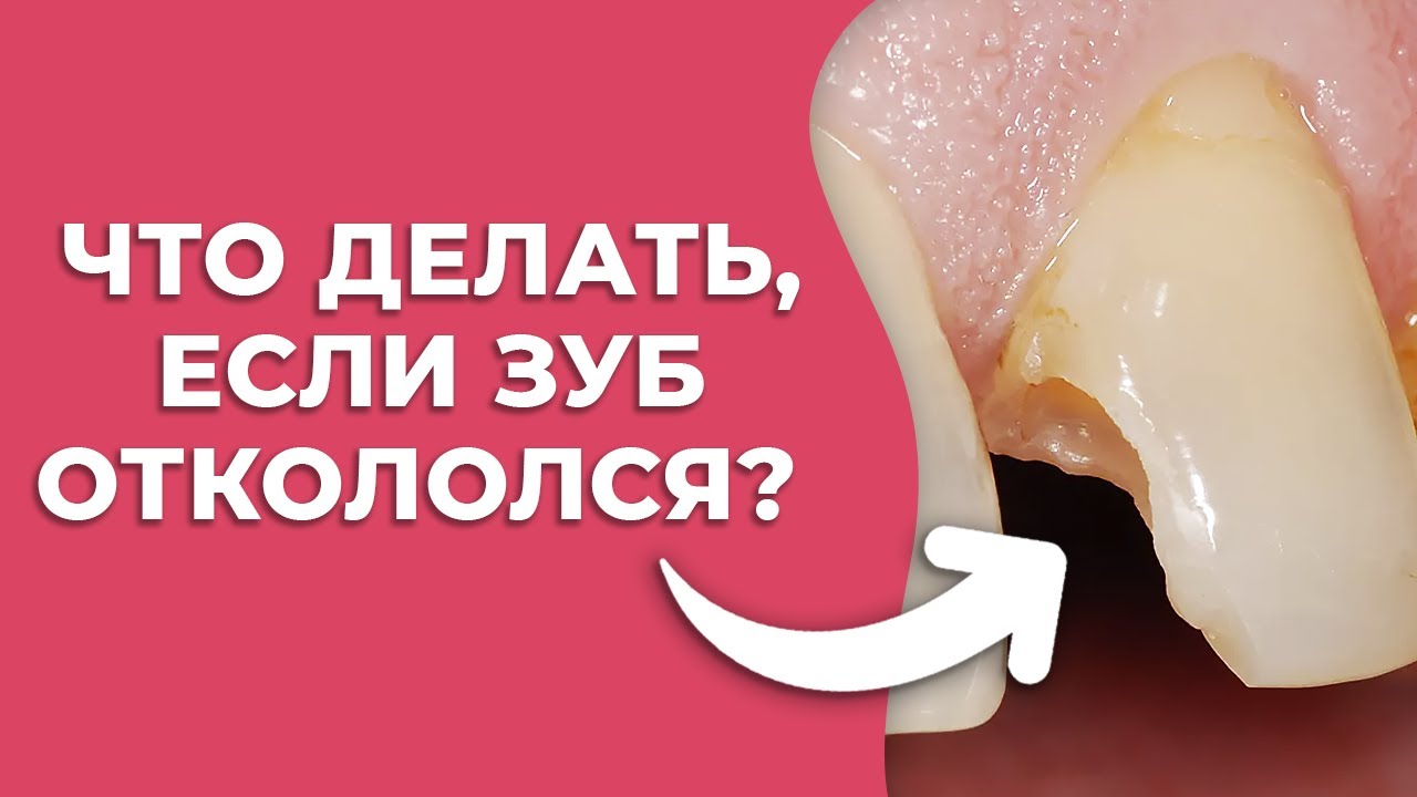 Откололся зуб. Что делать? / Причины сколов на зубах