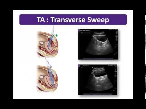 Video: Ntev Ntev Npaum Li Cas Lub Ultrasound Scan Ntsuas Ntev?