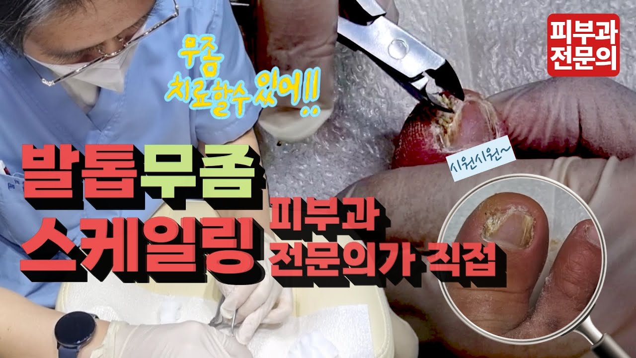 #손발톱무좀🦶 치료&스케일링 치료 모든것! #피부과전문의