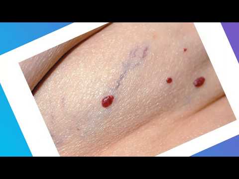 Video: Hemangioma - Hemangiomas Veidi Un Simptomi