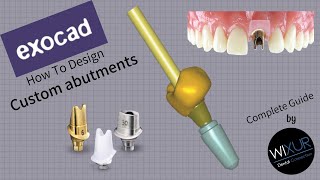 How To Design A Custom Abutment