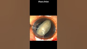 " Make it Pop out" - Nucleus prolapse with a Sinskey