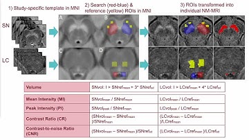 OHBM 2018 | Oral Session | Ludovica Griffanti | Automated measures from neuromelanin MRI reveal ne…