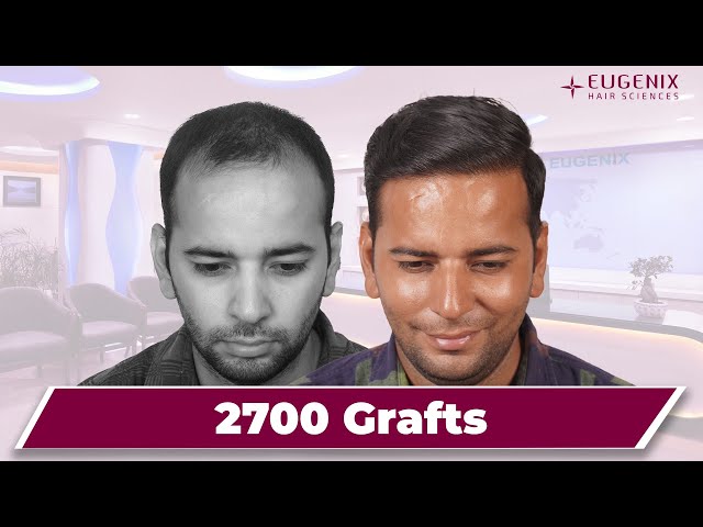 10 Months Hair Transplant Update | 2560 Grafts Norwood Grade 4A @Eugenix  Hair Sciences - YouTube