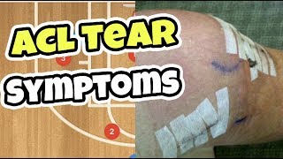 What Does an ACL Tear Feel Like | ACL Tear Symptoms