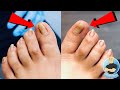 PINCER PERFECT TOENAILS?! ***FIXING CURVED NAIL SHAPE WITHOUT SURGERY***