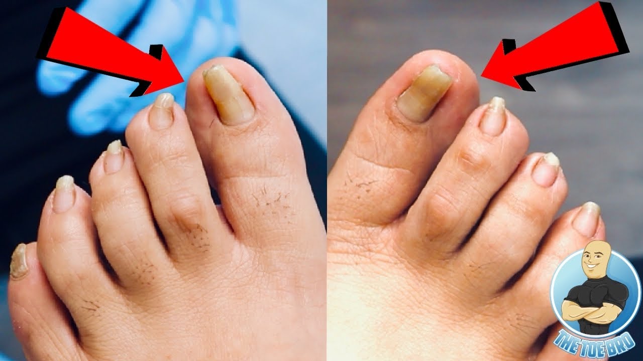 PINCER PERFECT TOENAILS?! ***FIXING CURVED NAIL SHAPE