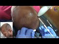 PRP - Patient From Nagpur || Best Hair Transplant Clinic || Hair Transplant in Maharashtra