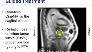 Moffitt  MR Guided Treatment