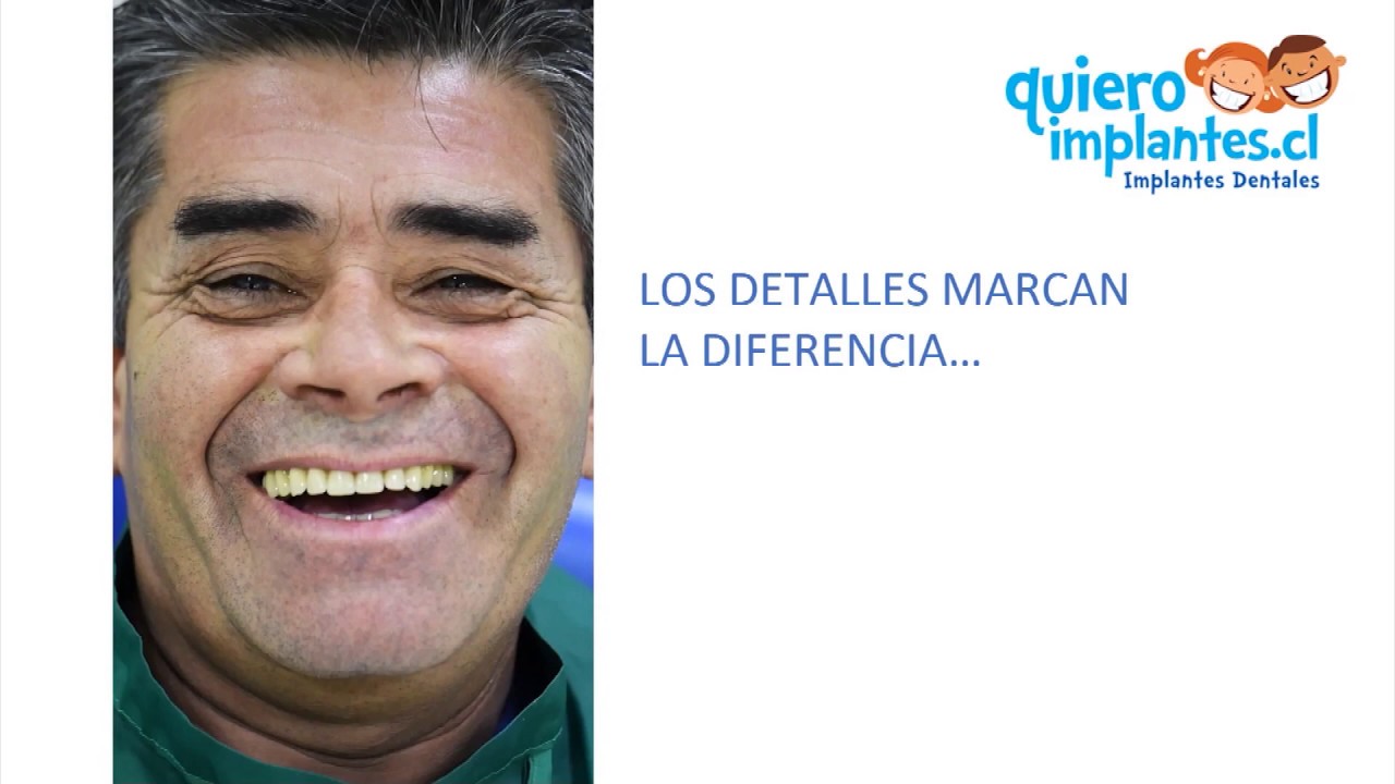 ENTREVISTA CASO CLINICO, IMPLANTES DENTALES