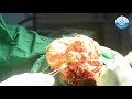 Knee amputation  dr roy varghese