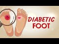 What are signs of Diabetic Foot | Prevention Tips and Treatment