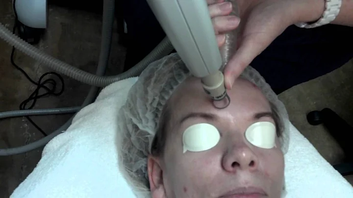 Pixel Laser Resurfacing Process Dr. Janie Simmons,...