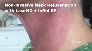 Non-Invasive Neck Rejuvenation w/ LaseMD   Infini RF | Nina S. Naidu MD FACS - NYC Plastic Surgery