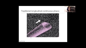 Phaco Fundamentals II