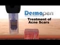 MicroNeedling for Acne Scars - Dermapen® Treatment