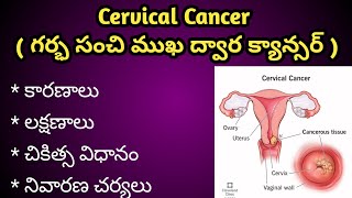 Cervical Cancer ( గర్భ సంచి ముఖ ద్వారం క్యాన్సర్ ) Causes, Symptoms and Treatment in Telugu.