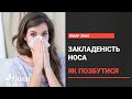 Як позбутися від закладеності носа: швидке лікування