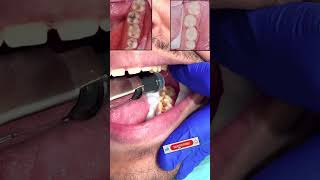 Wisdom tooth caries removal | تنظيف تسوس ضرس العقل و حشو تجميلي