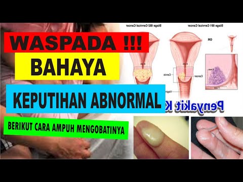 bahaya,-penyebab-dan-cara-ampuh-mengobati-keputihan-pada-wanita