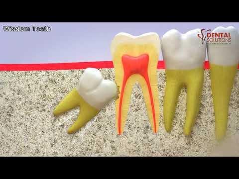 Video: Ar išdygsta visi protiniai dantys?