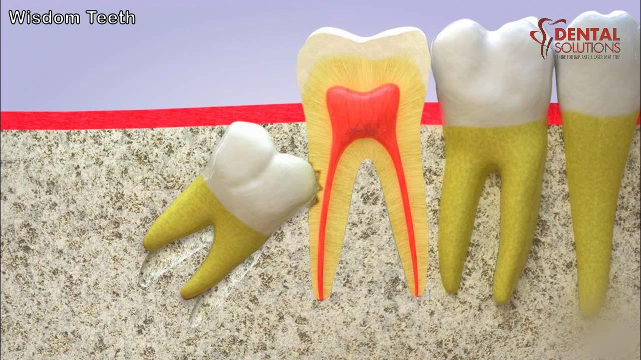 All you need to know about the eruption of a wisdom tooth YouTube