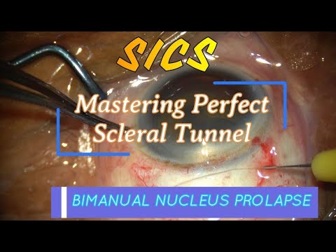 TIPS FOR SICS TUNNEL MAKING & TIPS & TRICKS OF BIMANUAL NUCLEUS PROLAPSE (FOR RESIDENTS) TRAINING
