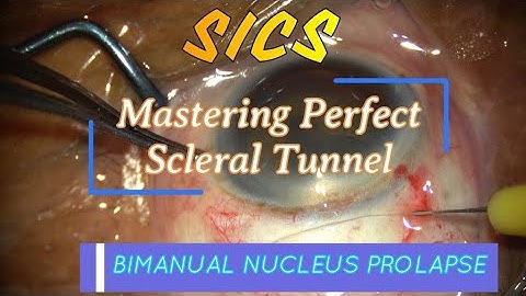 TIPS FOR SICS TUNNEL MAKING & TIPS & TRICKS OF BIMANUAL NUCLEUS PROLAPSE (FOR RESIDENTS) TRAINING