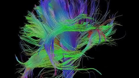 Diffusion Tractography MRI - William Edward Hahn #shorts