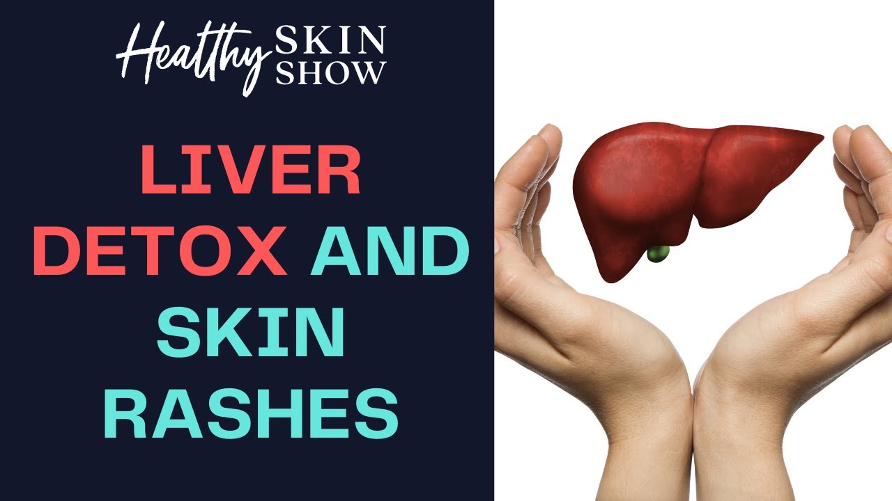 hives liver detox