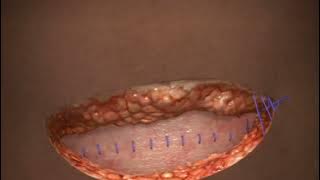 Cesarean delivery / c-section : Surgical technique - HD Video