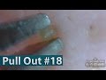 #18 Pull Out Blackheads Close up - Blackheads Removal