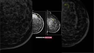 Do You Need A Mammogram While Breastfeeding?