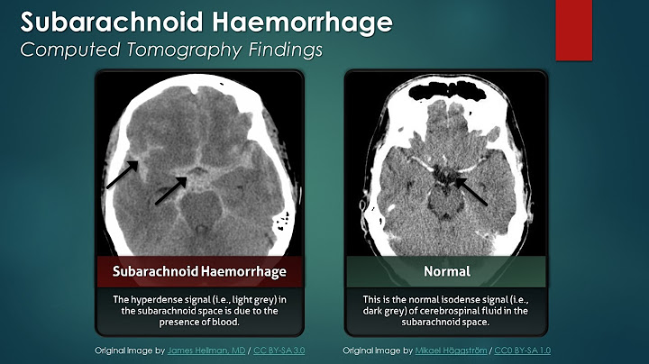 Subarachnoid Hemorrhage (SAH): Computed Tomography Scan Findings