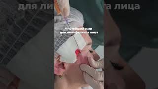 ВАШ ЖИР-лучшая замена филлерам, знали? #липофилинг #красота #пластическийхирург