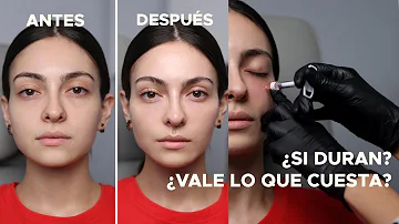 ¿Merecen la pena los rellenos faciales?