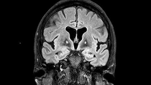 Hallovorden Spatz syndrome