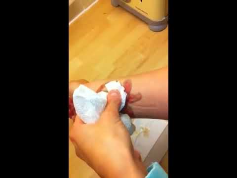 Laser Tattoo Removal Blister - YouTube